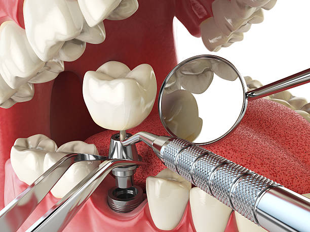 Best Dental Abscess Treatment in Inwood, FL